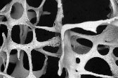 Osteoporitic Bone