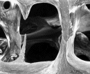 Image: Bone erosion