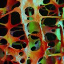 Image: Osteoporotic erosion
