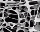 Image: osteoporotic erosion
